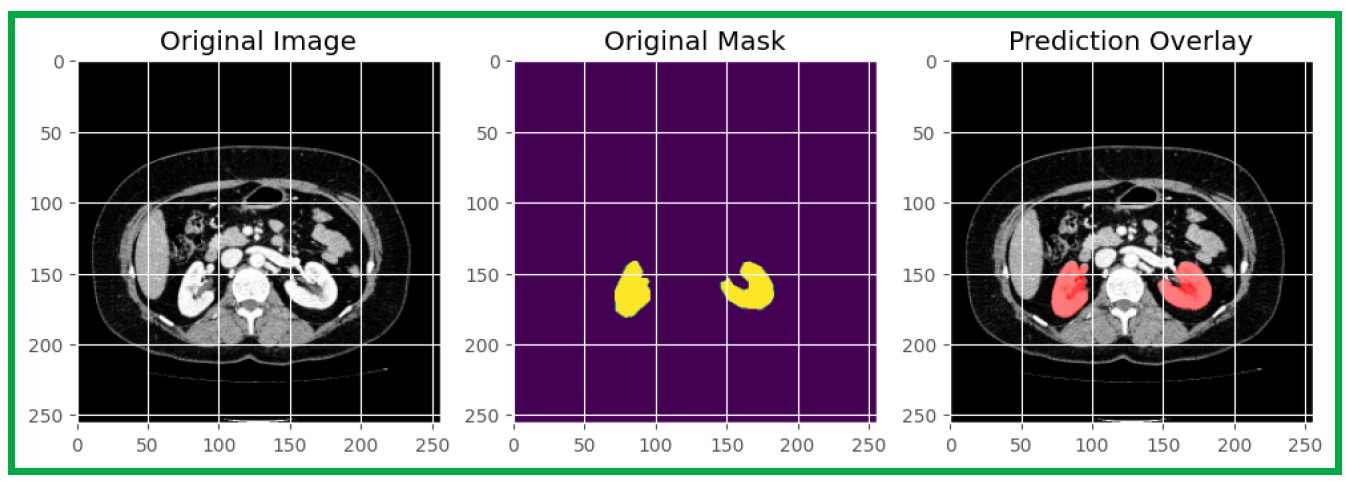 Böbrek Segmentasyonu